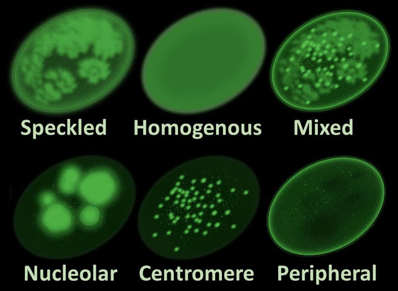Hat zöld fluoreszcens mikroszkópos minta angol felirattal (Speckled, Homogenous, Mixed, Nucleolar, Centromere, Peripheral), amelyek az ANA-teszt jellegzetes festődési mintázatait mutatják